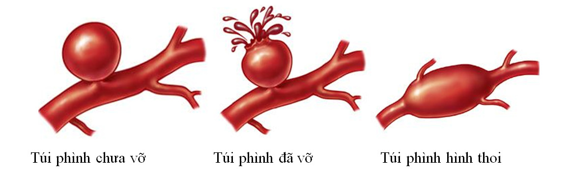 Độ dày của túi phình là một trong những yếu tố giúp nhận diện túi phình liệu có sắp vỡ không.