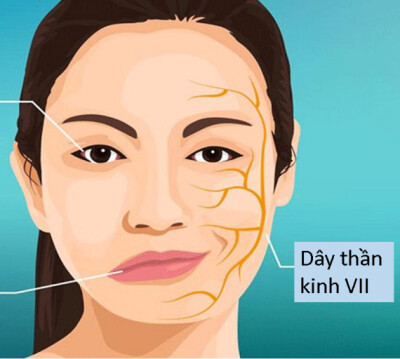 Cách phân biệt liệt dây thần kinh số VII và đột quỵ?