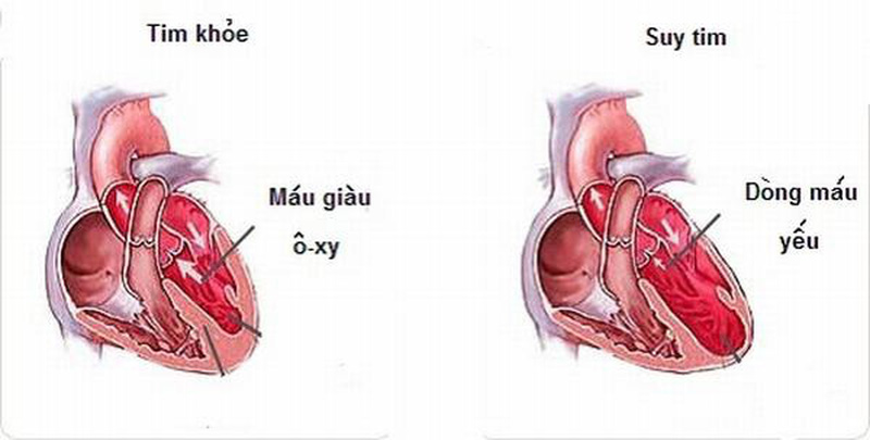 Bệnh động mạch vành không điều trị sẽ gây ra hậu quả gì?