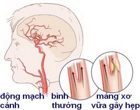 Bệnh động mạch cảnh là gì?
