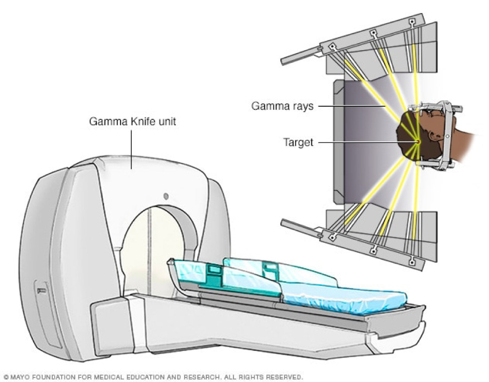 Quá trình điều trị gamma knife tiến hành ra sao?