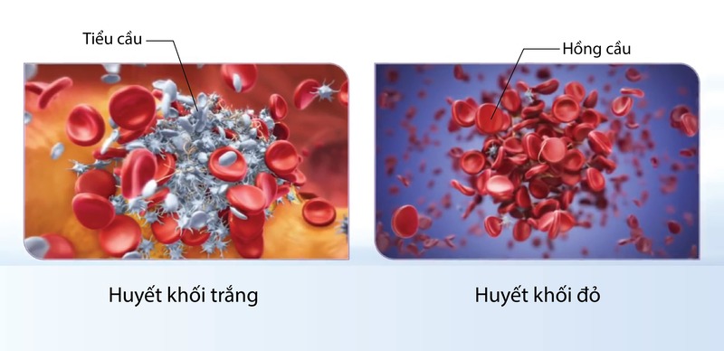 Nếu kết quả là âm tính, rất có thể bạn không gặp vấn đề với cục máu đông, chẳng hạn như huyết khối tĩnh mạch sâu.