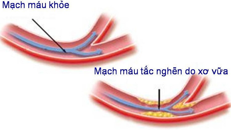 Nguyên nhân dẫn đến bệnh động mạch cảnh?