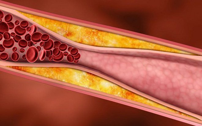 Hội chứng mạch vành cấp tính thường là kết quả của sự tích tụ chất béo tạo thành mảng xơ vữa trong và trên thành của động mạch vành - các mạch máu cung cấp oxy và chất dinh dưỡng đến cơ tim.