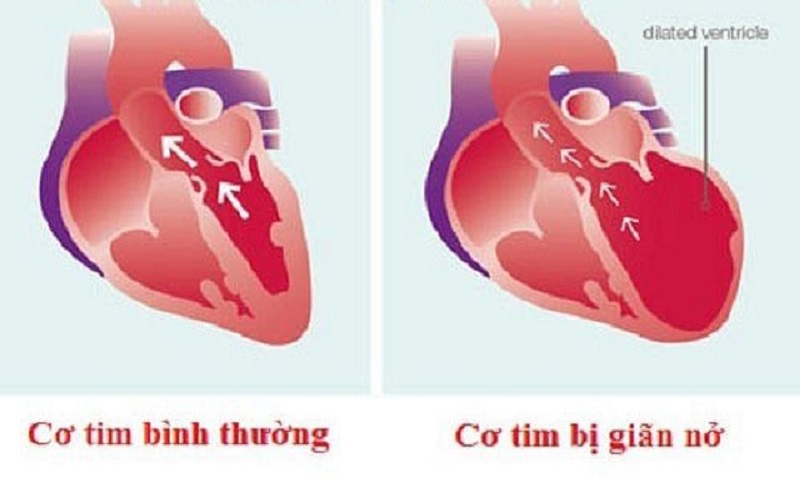 Bệnh cơ tim giãn khởi phát một cách âm thầm, ban đầu nó có thể không gây ra các triệu chứng