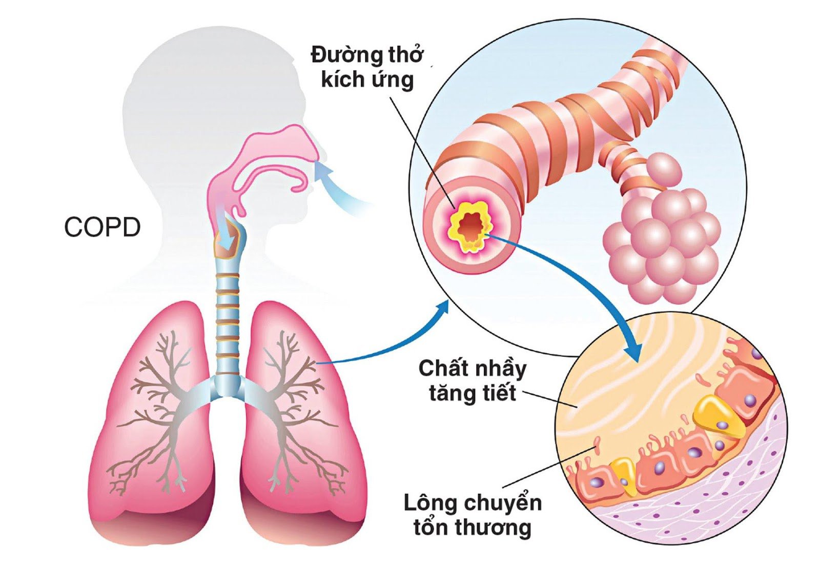COPD gây ra các triệu chứng như khó thở, ho, tiết chất nhầy (đờm),... là một trong những nguyên nhân gây suy tim bên phải