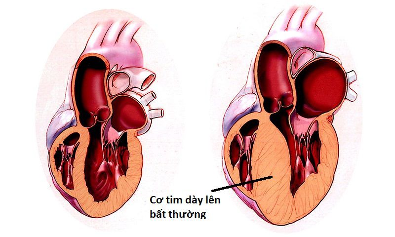Cơ tim phì đại là một loại bệnh tim phức tạp ảnh hưởng đến cơ tim.