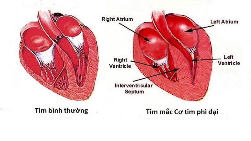 Mục tiêu điều trị là giảm thiểu hoặc ngăn ngừa các triệu chứng và giảm nguy cơ biến chứng, chẳng hạn như suy tim và đột tử do tim.