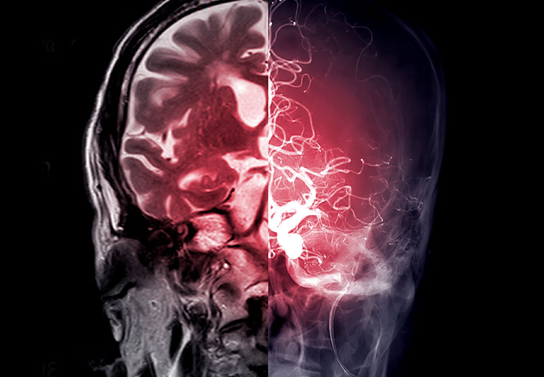 Khoảng 25% đột quỵ do thiếu máu cục bộ là do crypto, có nghĩa là các xét nghiệm không cho thấy nguyên nhân chính xác.