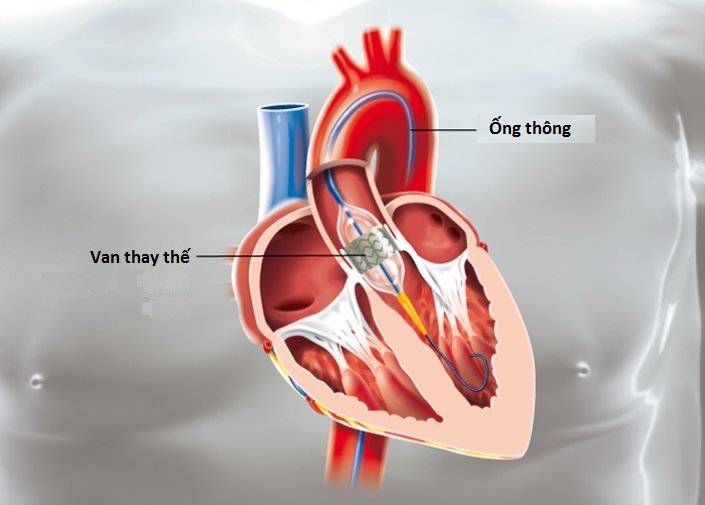 Trong trường hợp không có chỉ định sửa chữa van, thay thế van là một lựa chọn. Van có thể được thay thế bằng van hiến tặng (thường từ động vật như bò hoặc lợn), van cơ học hoặc van nhân tạo.