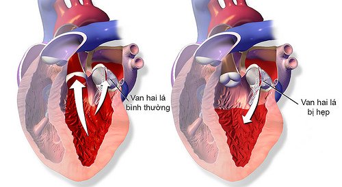 Bệnh hẹp van hai lá có gây nguy cơ đột quỵ?