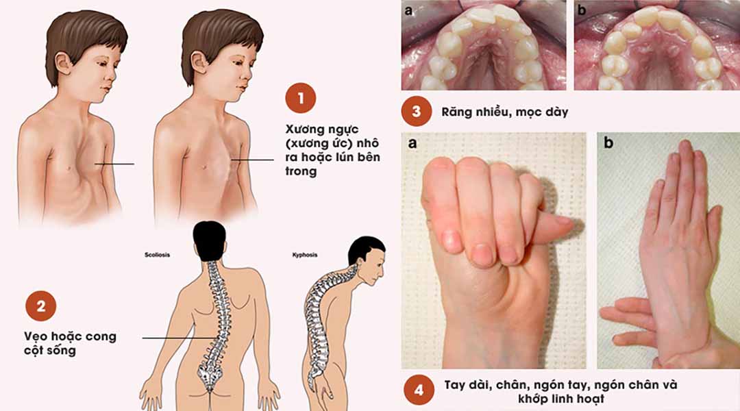 Hội chứng Marfan làm tăng nguy cơ xuất huyết nội sọ thế nào?