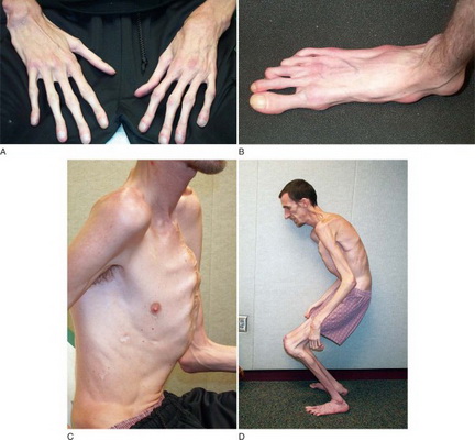 Hội chứng này là một tình trạng ảnh hưởng đến mô liên kết, bao gồm tim và mạch máu, xương, gân, sụn, mắt, da và phổi.