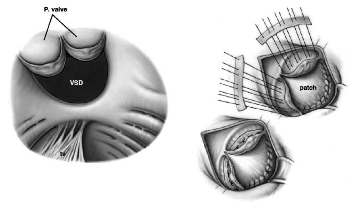 Phẫu thuật đóng lỗ thông liên thất.