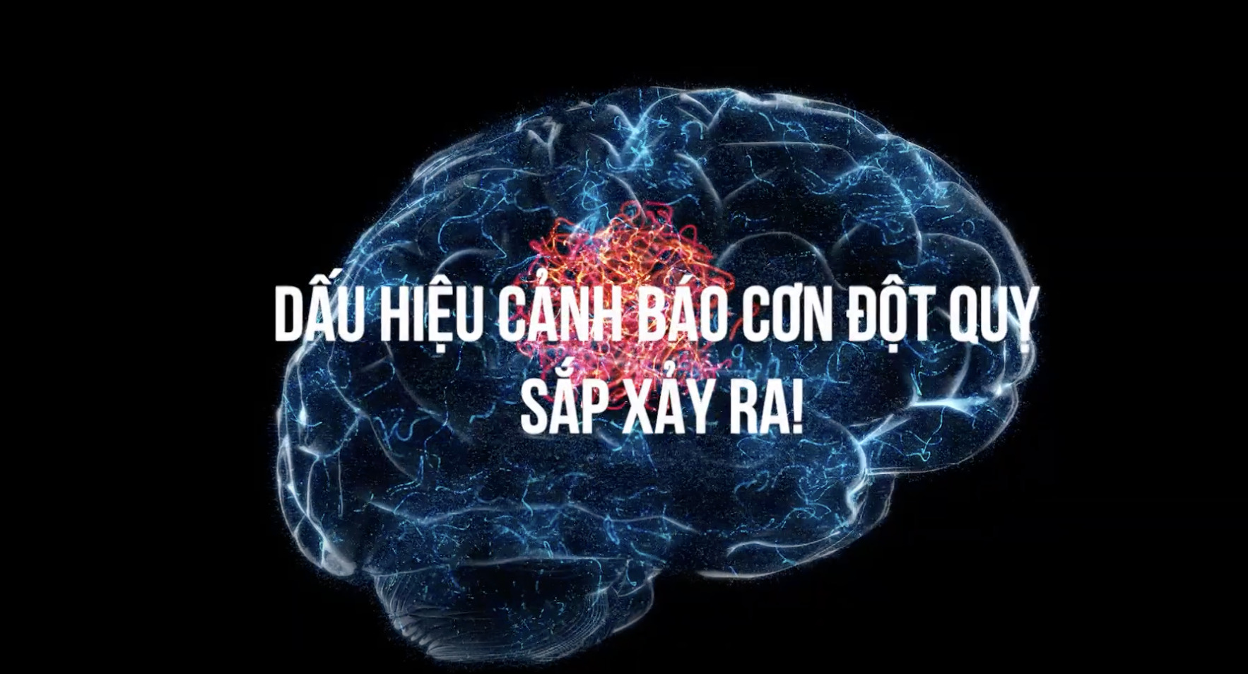 Dấu hiệu cảnh báo cơn đột quỵ sắp xảy ra