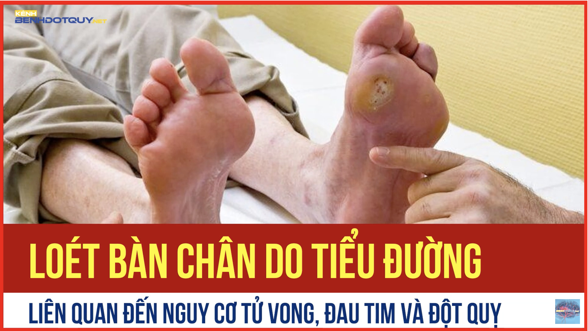 Loét bàn chân do tiểu đường làm tăng nguy cơ tử vong đau tim, đột quỵ
