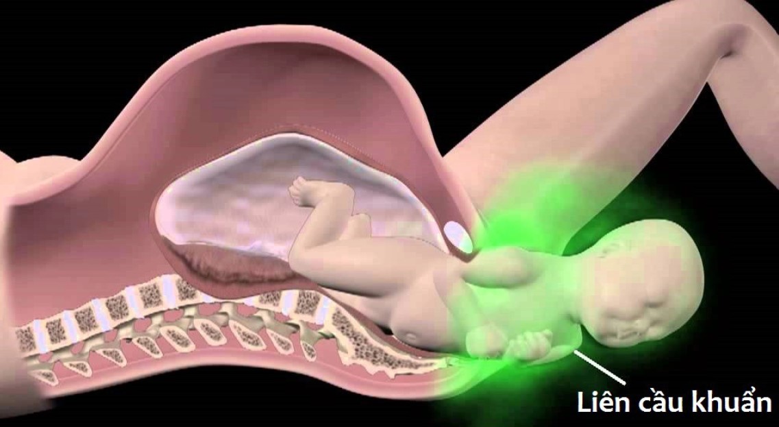 Nhiễm khuẩn liên cầu nhóm B xảy ra do mẹ truyền cho con trong quá trình sinh