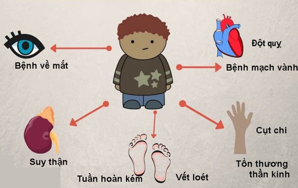 Biến chứng tiểu đường loại 1 có thể dẫn đến đột quỵ