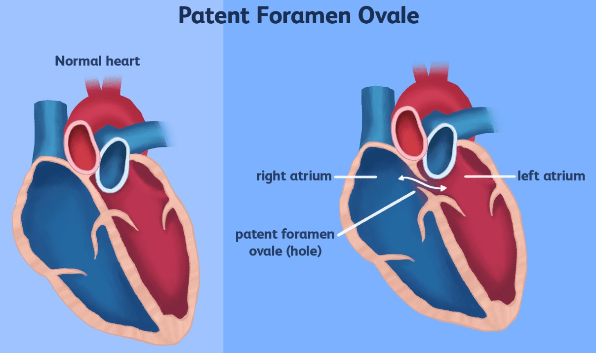 Lỗ thông bầu dục (PFO) là một lỗ nằm giữa tâm nhĩ trái và phải (buồng trên) của tim.