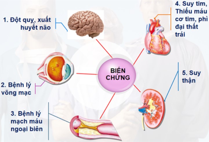 Cao huyết áp là "sát thủ" có thể dẫn đến nhiều biến chứng nguy hiểm cho cơ thể