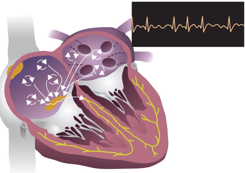 Rung nhĩ là một trong những nguyên nhân dẫn đến đột quỵ não, chiếm khoảng 25% trong tổng số các trường hợp.