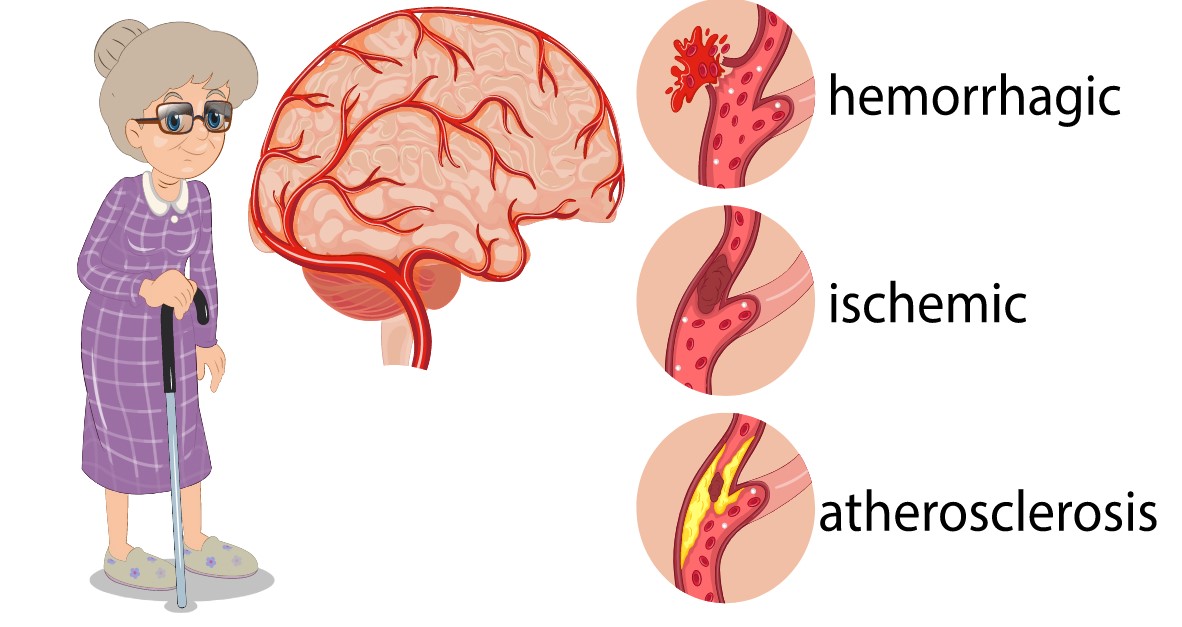 Đột quỵ thường xảy ra do tắc mạch hoặc vỡ mạch