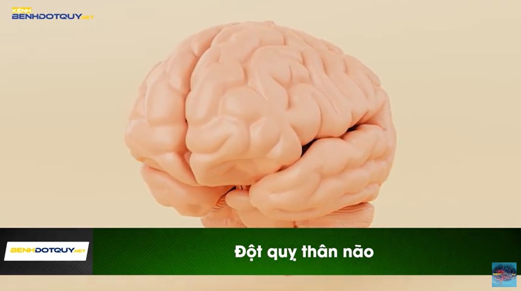 Đột quỵ thân não, dấu hiệu nào nhận biết?