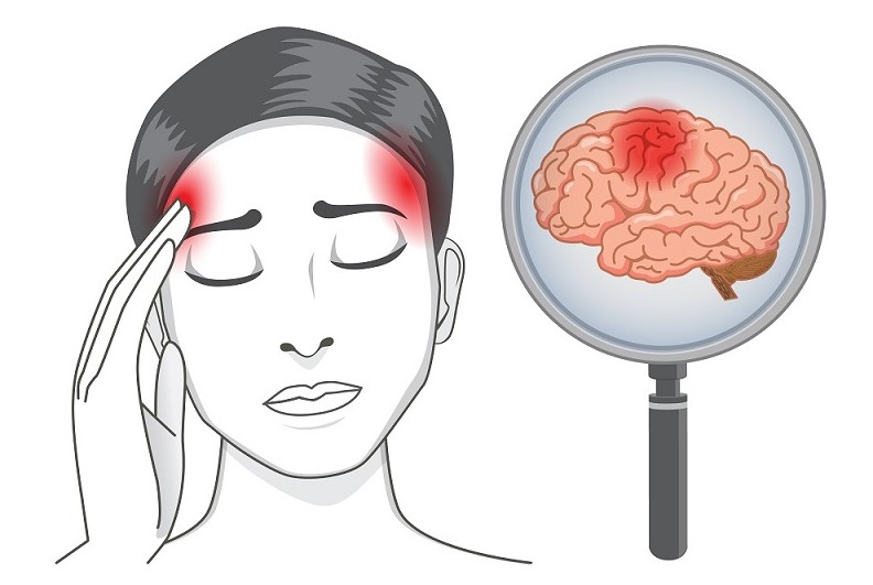 Đau đầu sau đột quỵ có thể là cảm giác đau nhói nhưng cũng có thể đau dữ dội kèm buồn nôn, chóng mặt và mệt mỏi trong cơ thể.