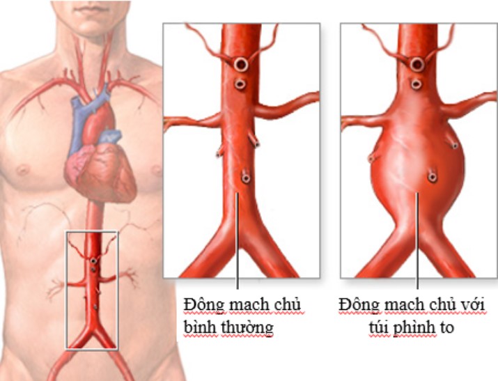 Mức độ nguy hiểm của vỡ túi phình động mạch chủ bụng