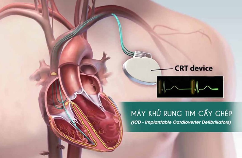 Máy khử rung tim cấy được ( ICD –Implantable Cardioverter Defibrillator) là một thiết bị y tế được cấy vào dưới da bệnh nhân