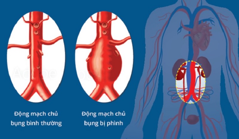 Phình động mạch chủ bụng là gì?