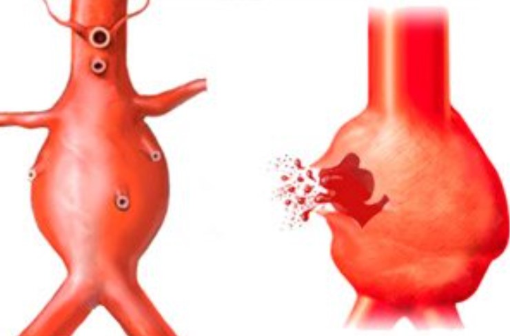 Mức độ nguy hiểm khi vỡ túi phình động mạch chủ bụng?