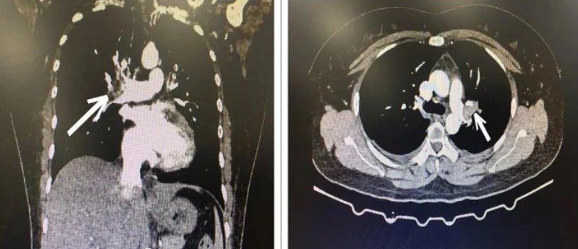 Người phụ nữ bị tắc động mạch phổi do uống 15 viên thuốc tránh thai khẩn cấp/tháng
