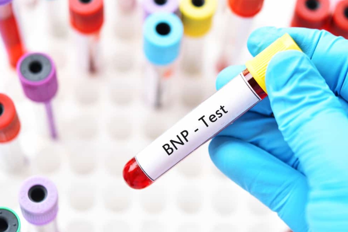 Xét nghiệm BNP là viết tắt của B-type Natriuretic Peptide, nghĩa là xét nghiệm định lượng lượng hormone BNP có trong máu người.