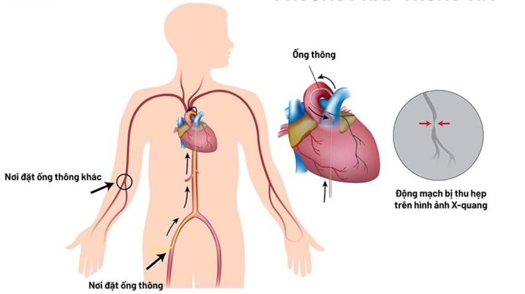 Thông tim là thủ thuật dùng để chẩn đoán và điều trị một số vấn đề về tim mạch.