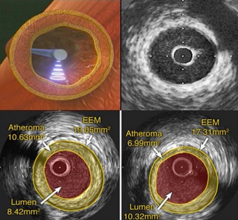 Sơ đồ các thông số đo được trên IVUS (A), và hình ảnh mô tả cách đo một trường hợp thực tế.