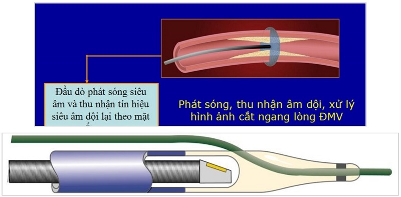 Hình ảnh mô tả nguyên lý IVUS (trên) và đầu dò IVUS gắn trên catheter (dưới)