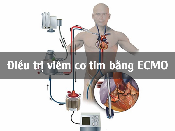 Bệnh viêm cơ tim cấp thường xuất hiện ở những người trẻ từ 20 - 40 tuổi.