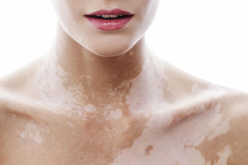 Bệnh bạch biến có thể gặp ở nhiều lứa tuổi, ở mọi giới tính.