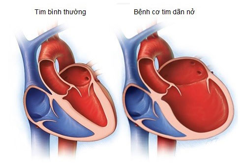 Bệnh cơ tim giãn nở: Tất tần tật những điều cần biết