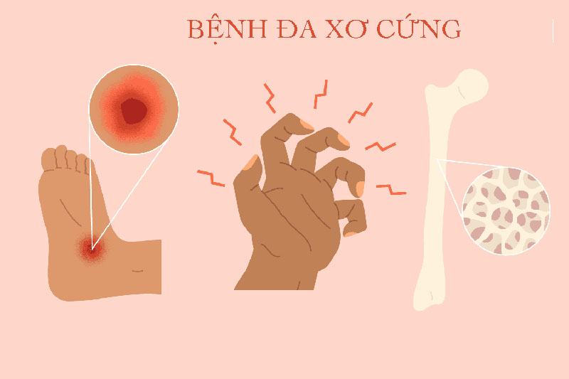 Đa xơ cứng hay còn gọi xơ cứng rải rác là bệnh tự miễn có ảnh hưởng đến các tế bào thần kinh ở não và tủy sống.