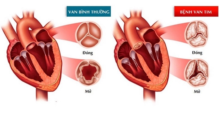 Phẫu thuật van tim được thực hiện để điều trị bệnh van tim.