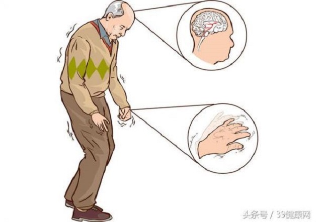 Bệnh Parkinson là một trong những bệnh về thần kinh, thường xảy ra khi nhóm tế bào trong não bị thoái hóa
