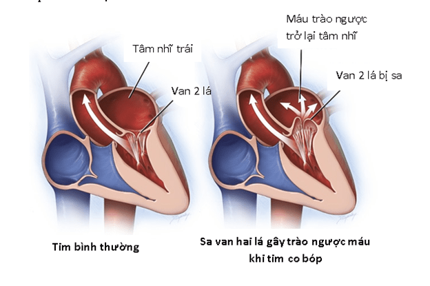 Bệnh lý này là một dạng bệnh van hai lá phổ biến và thường vô hại.