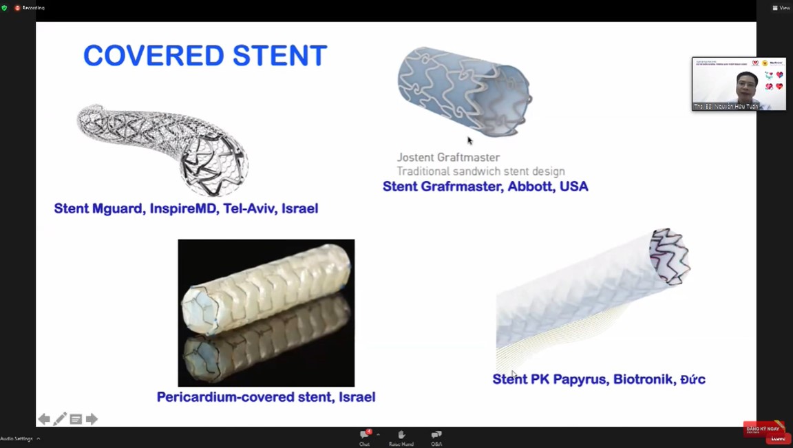 Các thiết kế stent hiện nay
