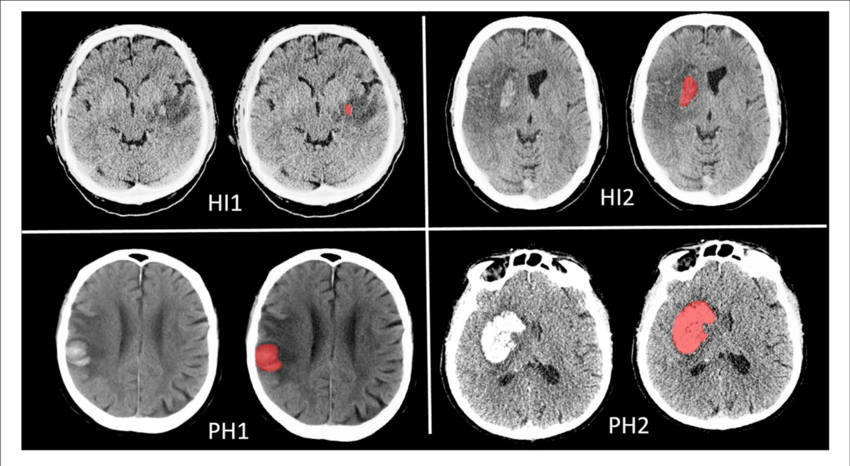Chuyển dạng xuất huyết sau nhồi máu não nguy hiểm thế nào?