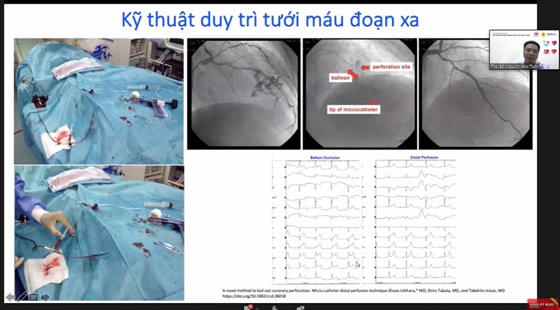 kỹ thuật tưới máu đoạn xa