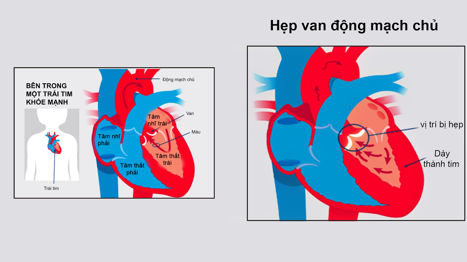 Khi vi khuẩn từ các bệnh nhiễm trùng không được điều trị đến máu, chúng có thể tích tụ trên van tim, khiến hệ thống miễn dịch tự làm hỏng van.
