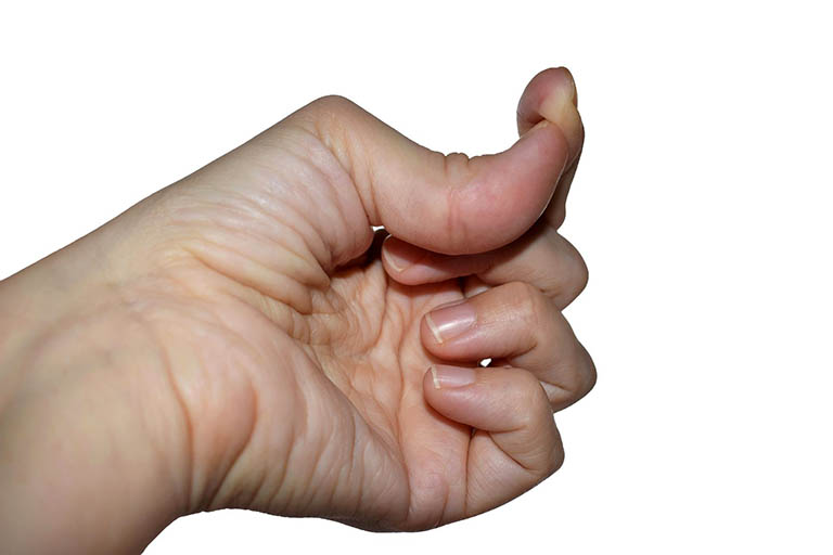 Những người bị tình trạng này có làn da mỏng hơn, trong mờ và mỏng manh.