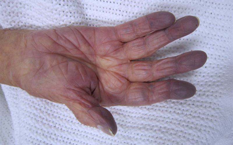 Ngón tay và da tím tái là những biểu hiện phổ biến của hội chứng.